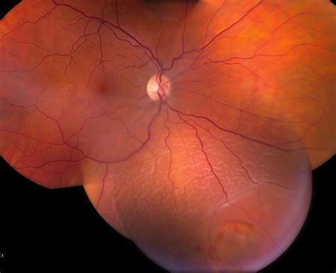 rhegmatogenous retinal detachment icd 10 ICD 10 code for Diabetes mellitus due to underlying condition with proliferative diabetic retinopathy with traction retinal detachment involving the macula, bilateral